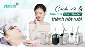 Mụn đầu đen thành nốt ruồi có thật không? Cách xử lý hiệu quả