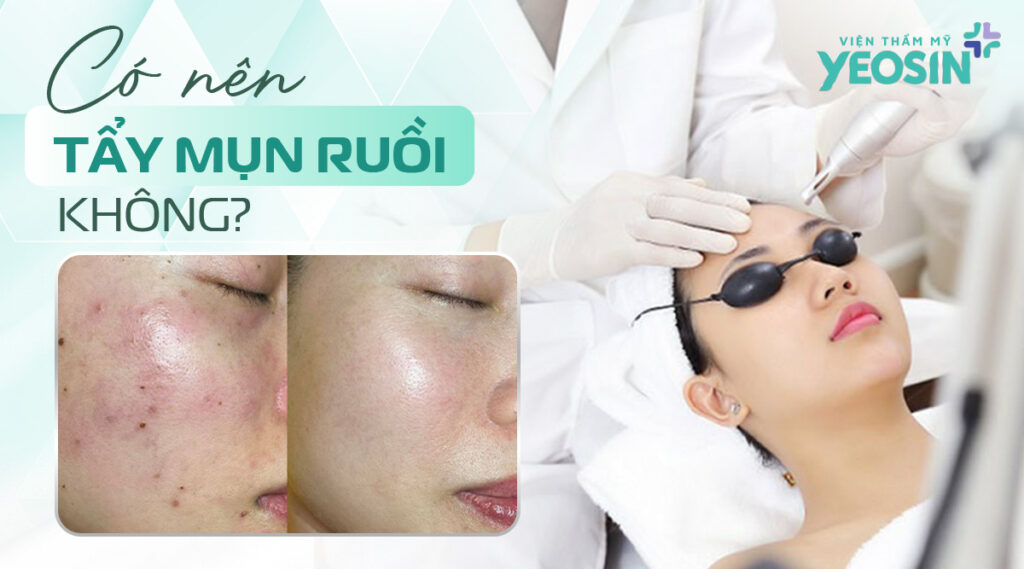 Góc giải đáp: Có nên tẩy mụn ruồi không? 8 Vậy có nên tẩy mụn ruồi không?