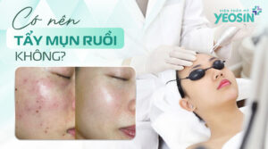 Vậy có nên tẩy mụn ruồi không?