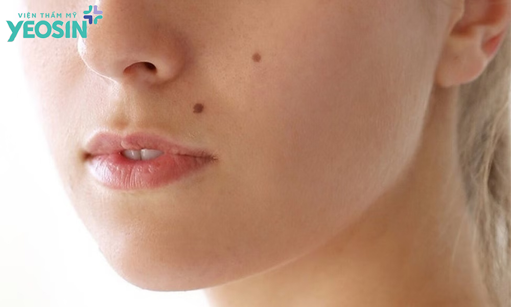 Nguyên nhân hình thành nốt ruồi là gì?