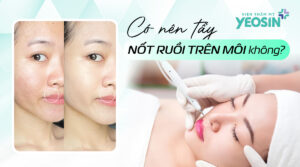 Nốt ruồi ở môi tốt hay xấu? Có nên tẩy nốt ruồi trên môi không?