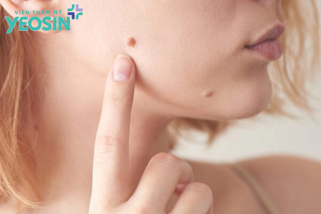 Giá tẩy nốt ruồi bao nhiêu tiền là hợp lý?