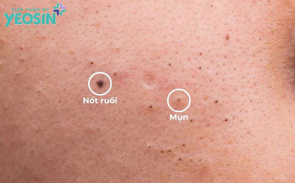 Tại sao có sự nhầm lẫn mụn đầu đen thành nốt ruồi