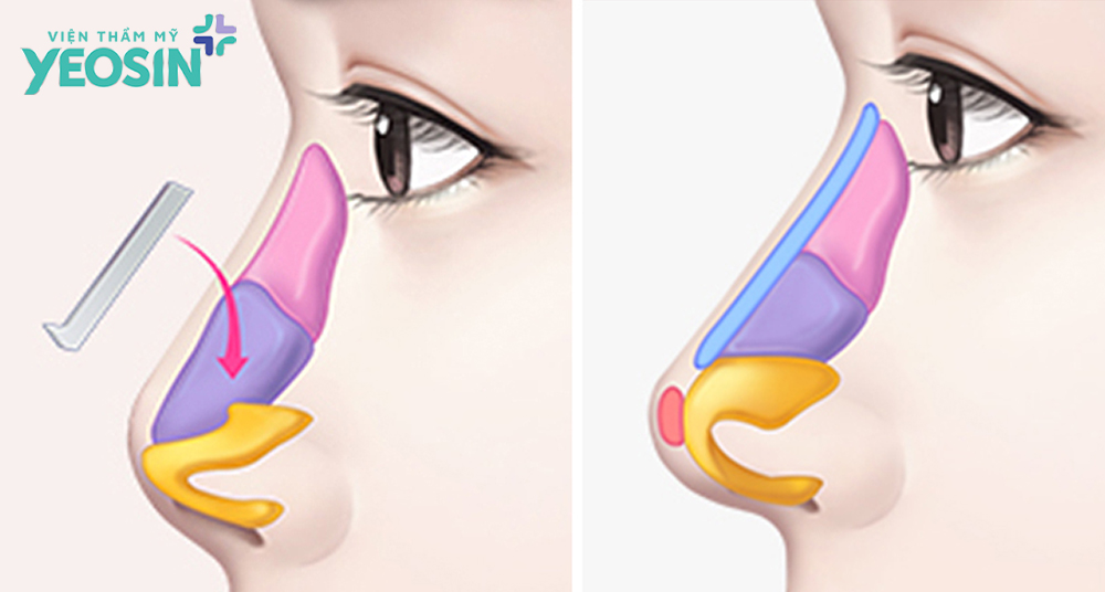 So sánh nâng mũi cấu trúc và nâng mũi bán cấu trúc