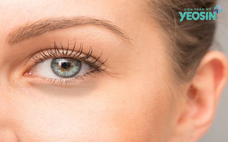 Thâm quầng mắt có trị được không?