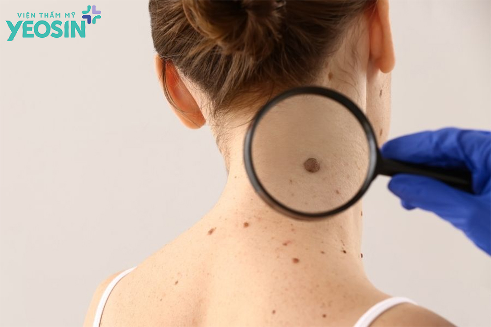 Những lưu ý khi xóa nốt ruồi lồi và to bạn cần biết