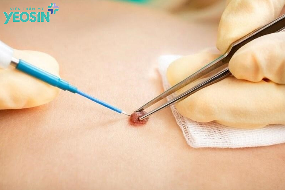 Các phương pháp tẩy nốt ruồi to và lồi