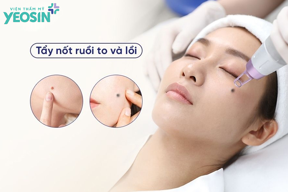 Tẩy nốt ruồi to và lồi có an toàn không