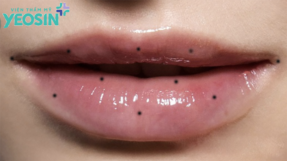 Ý nghĩa của nốt ruồi trên môi là gì?