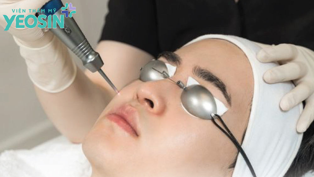 Tẩy nốt ruồi trên môi giá bao nhiêu tiền?