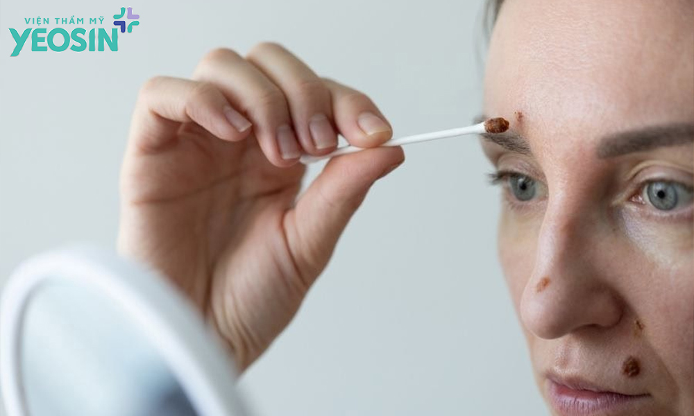 Kem tẩy nốt ruồi là gì?