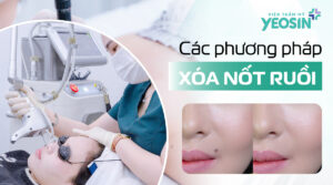 Các phương pháp tẩy nốt ruồi