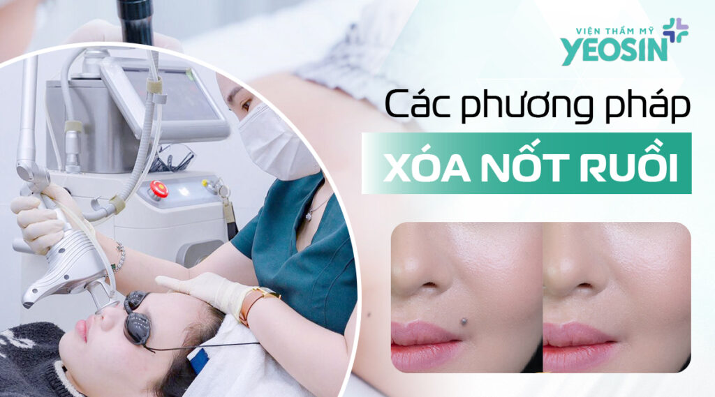 Các phương pháp xóa nốt ruồi trên mặt phổ biến.