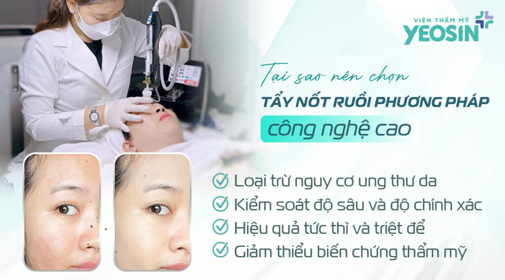 Các phương pháp tẩy nốt ruồi phổ biến nhất hiện nay 12 Tại sao nên chọn công nghệ cao thay vì phương pháp tẩy nốt ruồi bằng tự nhiên?