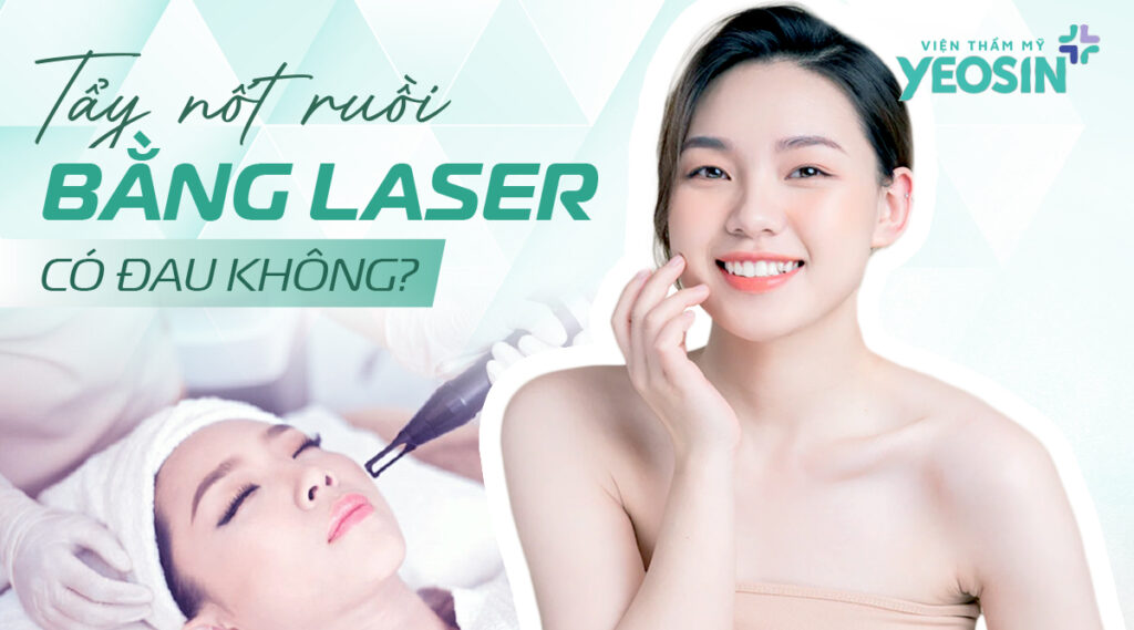 Tẩy nốt ruồi bằng laser có đau không?