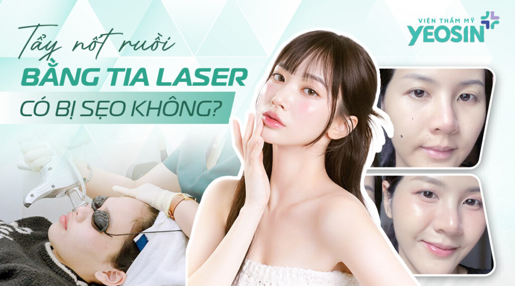 Xóa nốt ruồi bằng tia laser có bị sẹo không?