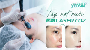 Tẩy nốt ruồi bằng laser CO2 và những điều cần biết