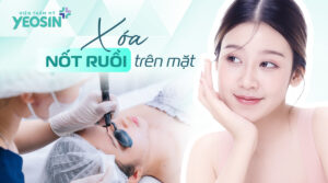 Xóa nốt ruồi trên mặt