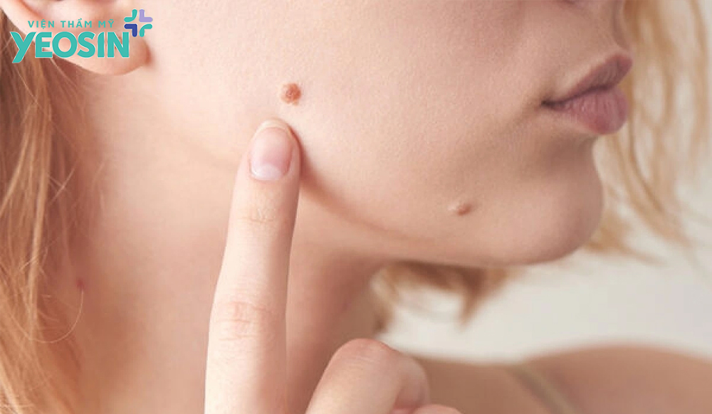 Những lưu ý khi xóa nốt ruồi trên mặt