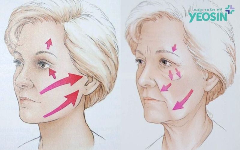 hiệu quả khác biệt chỉ có ở căng da tầng sâu SMAS