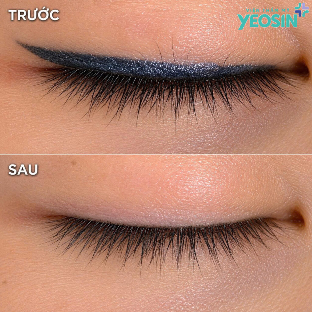 Hình ảnh sau khi xóa xăm mí mắt bằng laser Picosure Pro tại Yeosin