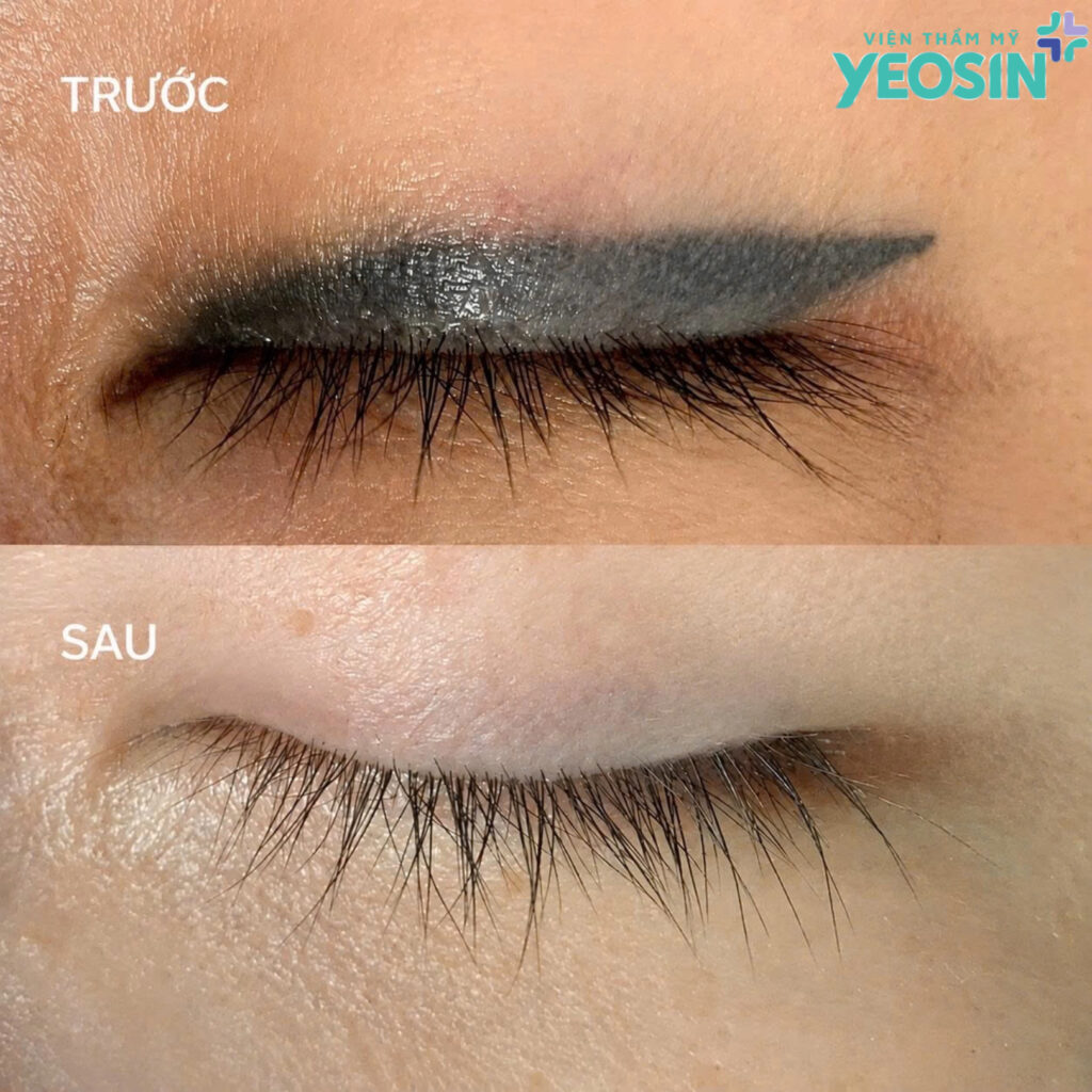 Hình ảnh sau khi xóa xăm mí mắt bằng laser Picosure Pro tại Yeosin