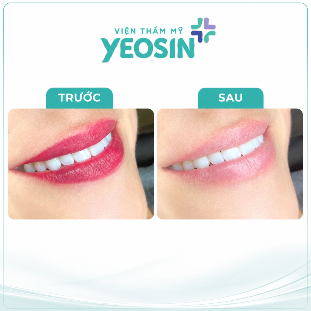 Hình ảnh trước và sau khi xóa xăm môi bằng tại Viện Thẩm Mỹ Yeosin