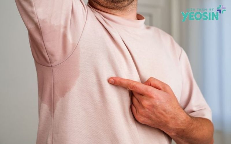 Loại bỏ tuyến mồ hôi nách: Giải pháp hỗ trợ giảm mồ hôi và hôi nách 12 Nguyên Nhân Khiến Tuyến Mồ Hôi Nách Hoạt Động Quá Mức