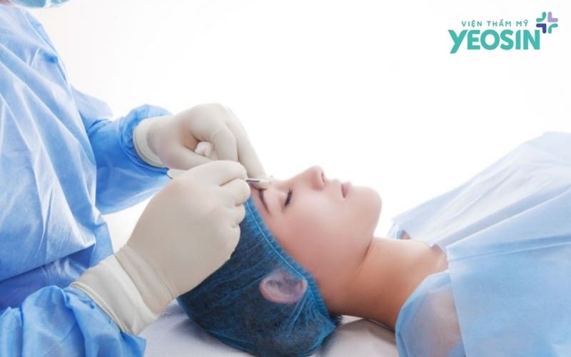 Các phương pháp lấy mỡ thừa mí mắt phổ biến