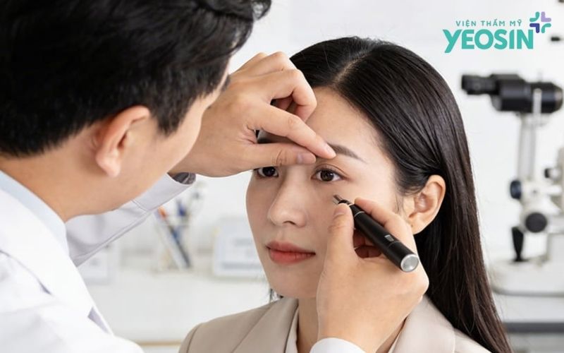 Quy trình lấy mỡ thừa mí mắt trên dưới