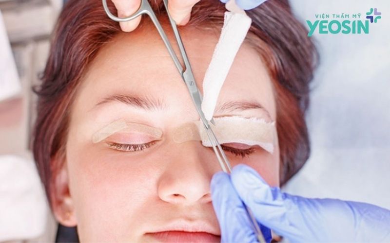 Chăm sóc sau khi lấy mỡ thừa mí mắt