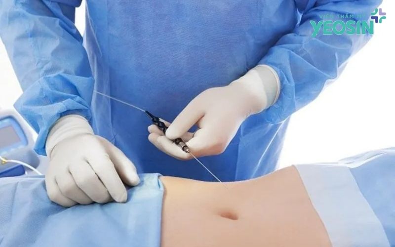 Công nghệ hút mỡ 360 độ - Tái tạo vòng eo con kiến 6 Công nghệ hút mỡ 360 độ là gì?