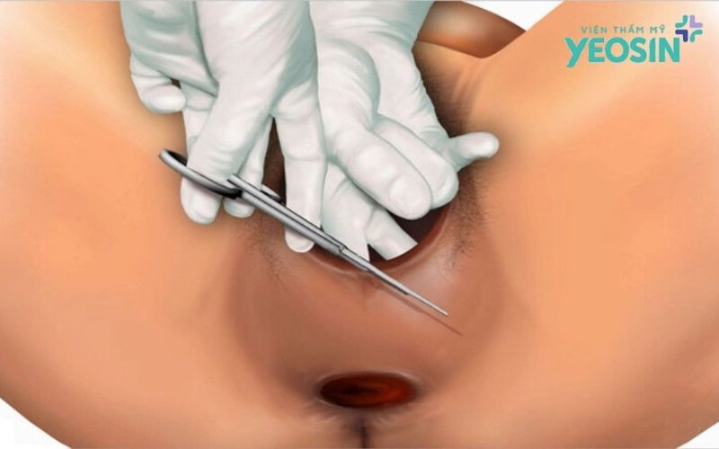 Tái tạo tầng sinh môn là gì?