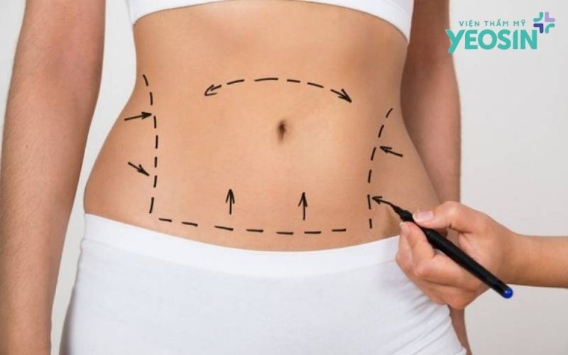 Công nghệ hút mỡ 360 độ - Tái tạo vòng eo con kiến 7 Quy trình hút mỡ bụng 360 độ chuẩn Y khoa, an toàn tại Yeosin
