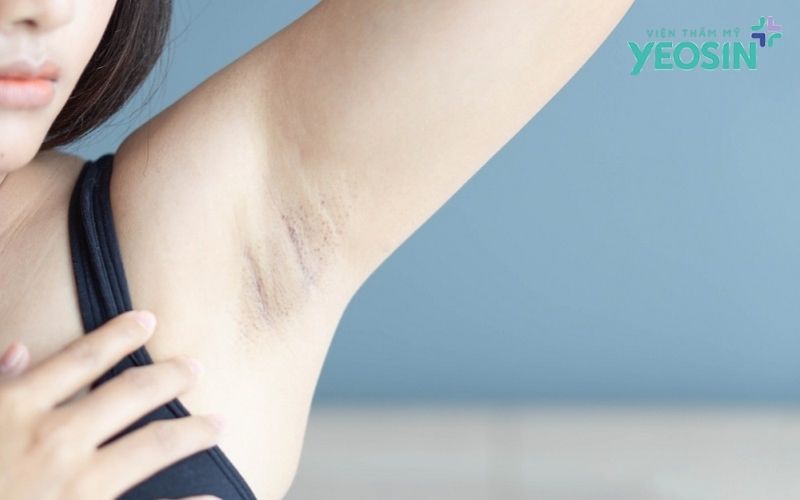 Trị Thâm Nách Hiệu Quả: Nguyên Nhân, Cách Khắc Phục 9 Trị thâm nách là gì? Vì sao nhiều người gặp tình trạng này?