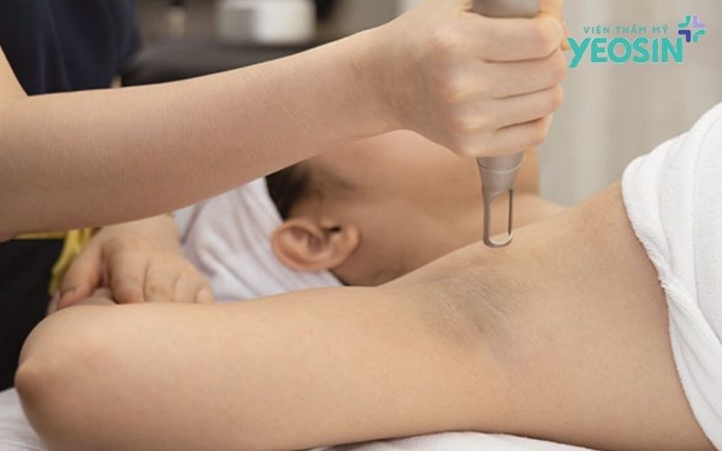 Trị Thâm Nách Hiệu Quả: Nguyên Nhân, Cách Khắc Phục 15 Quy trình trị thâm nách công nghệ Bio Skin tại Yeosin