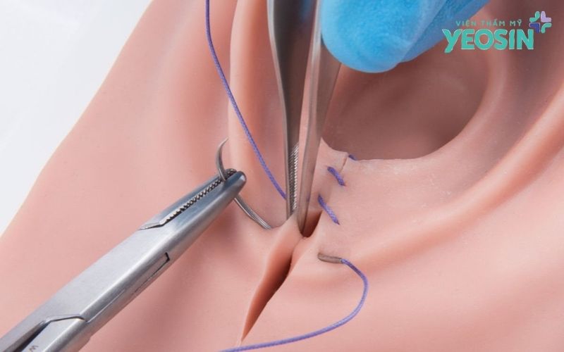 Quy trình tái tạo tầng sinh môn tại Yeosin