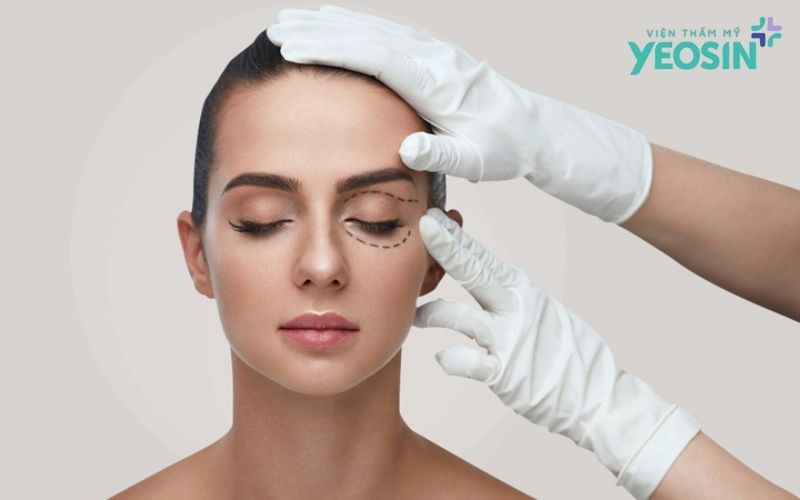 Vì sao cần lấy mỡ thừa mí mắt trên dưới?