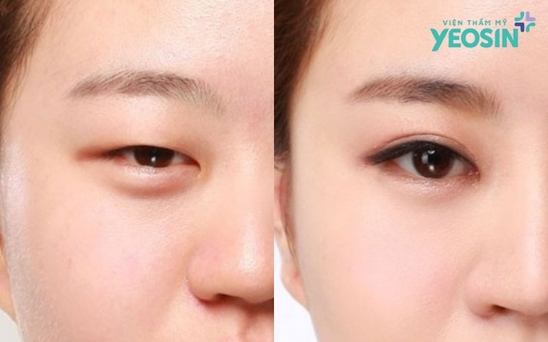 Phẫu thuật lấy mỡ thừa mí mắt có những ưu điểm gì?