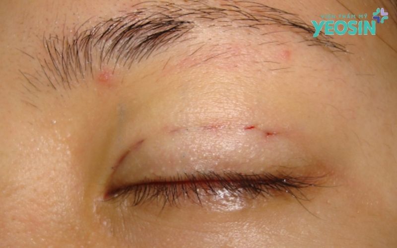 Lấy mỡ thừa mí mắt có ảnh hưởng đến mắt không?
