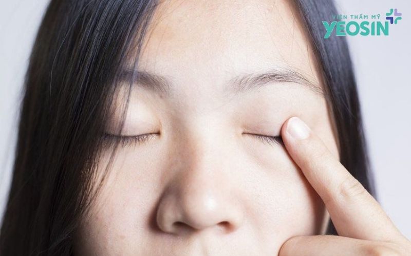 Lấy mỡ thừa mí mắt dành cho đối tượng nào?
