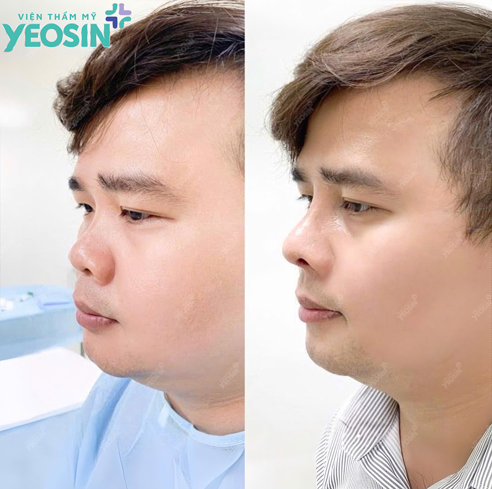 Hình ảnh trước và sau khi nâng mũi cho nam giới tại Viện Thẩm Mỹ Yeosin