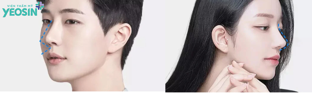 Nâng mũi cho nam giới đẹp tự nhiên và những lưu ý quan trọng 8 Nâng mũi nam giới khác gì so với nâng mũi nữ giới?