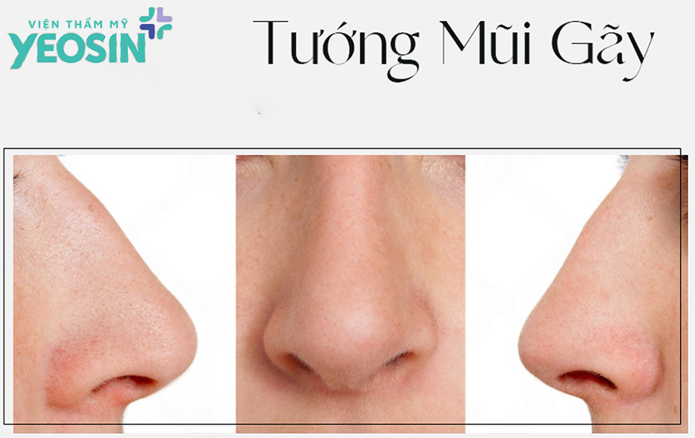 Những dáng mũi phong thủy không tốt