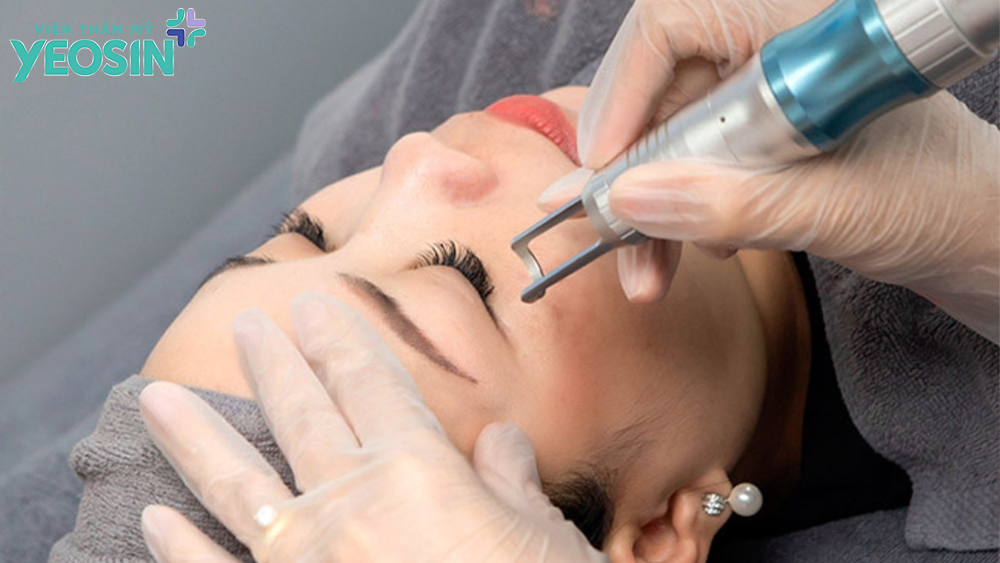 Quy trình xóa xăm mí mắt bằng Laser Picosure Pro tại Yeosin