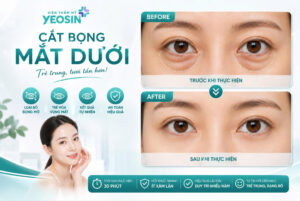 Cắt bọng mắt dưới - Có nên cắt mỡ bọng mắt dưới không?