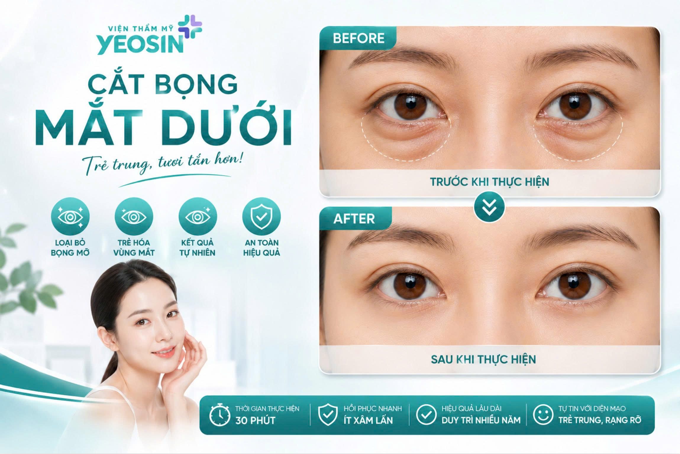 Cắt bọng mắt dưới - Có nên cắt mỡ bọng mắt dưới không?
