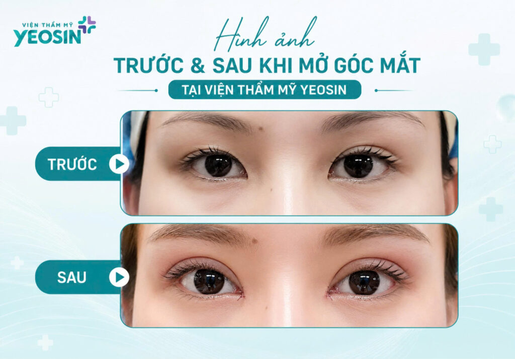 Hình ảnh trước và sau khi mở góc mắt đẹp tại Viện Thẩm Mỹ Yeosin
