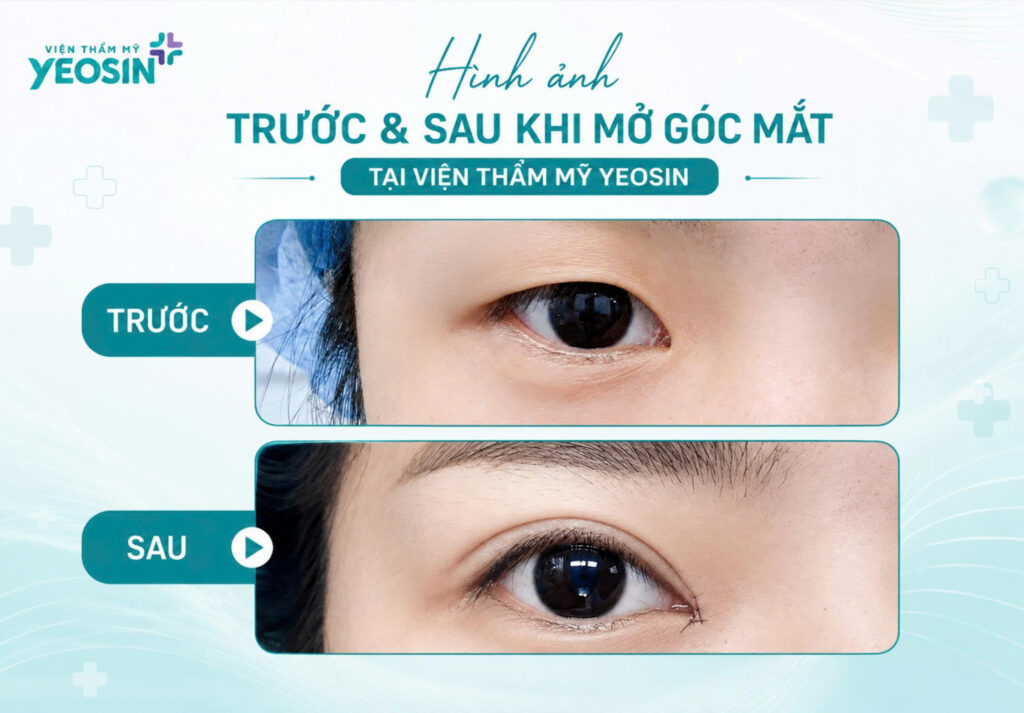Hình ảnh trước và sau khi mở góc mắt đẹp tại Viện Thẩm Mỹ Yeosin