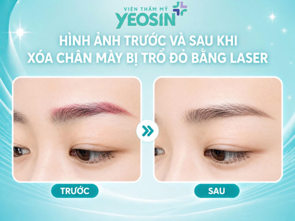 Hình ảnh trước và sau khi xóa chân mày bị trổ đỏ bằng laser tại Viện Thẩm Mỹ Yeosin.